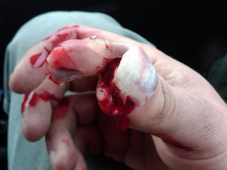 Illustration for article titled Blood Writes: "Cow crushed my thumb" (WARNING: STUPENDOUSLY GROSS)